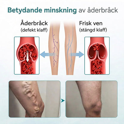 VenaLätt™  – Mikronål-patch för venstöd och lindring av tunga ben